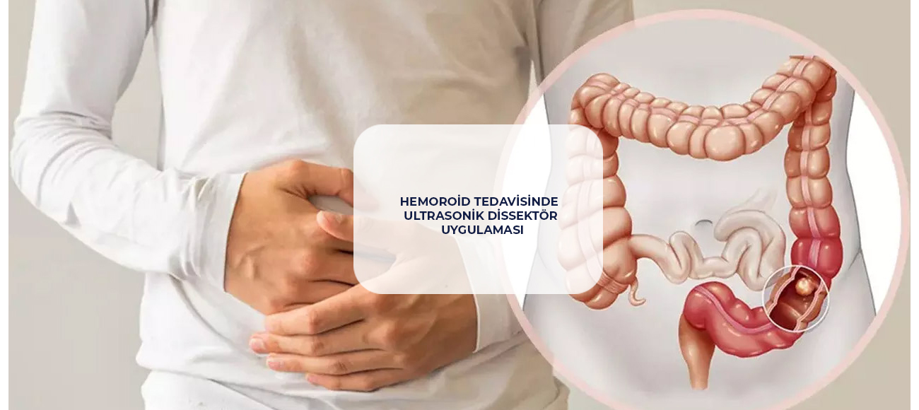 Ultrasonic Dissector Application in Hemorrhoid Treatment